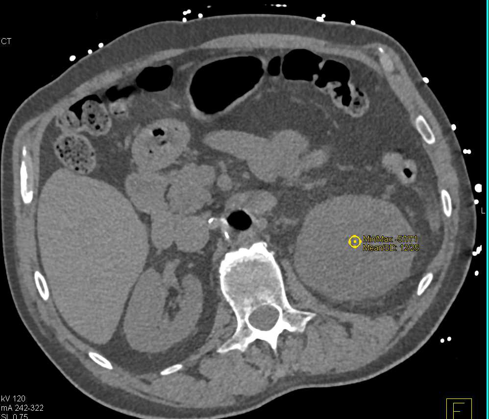 Left Renal Cell Carcinoma in a Patient with Intra-Aortic Ballon pump - CTisus CT Scan