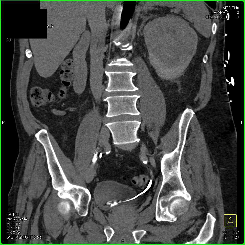 Papillary Renal Cell Carcinoma Left Kidney - CTisus CT Scan