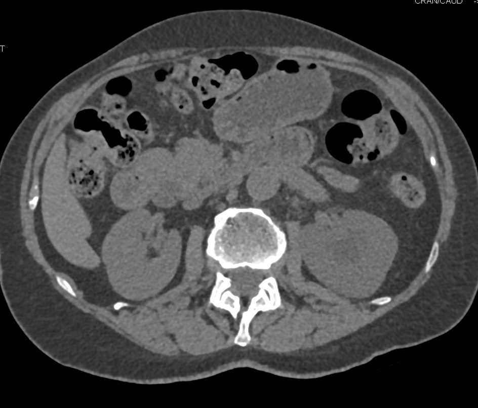 Multifocal Transitional Cell Carcinoma in Left Renal Pelvis and Bladder - CTisus CT Scan