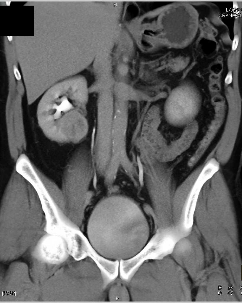 Incidental Papillary Right Renal Cell Carcinoma - CTisus CT Scan