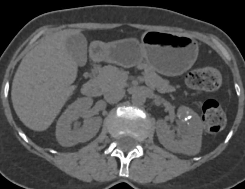 Bosniak 2F Cyst Left Kidney - CTisus CT Scan