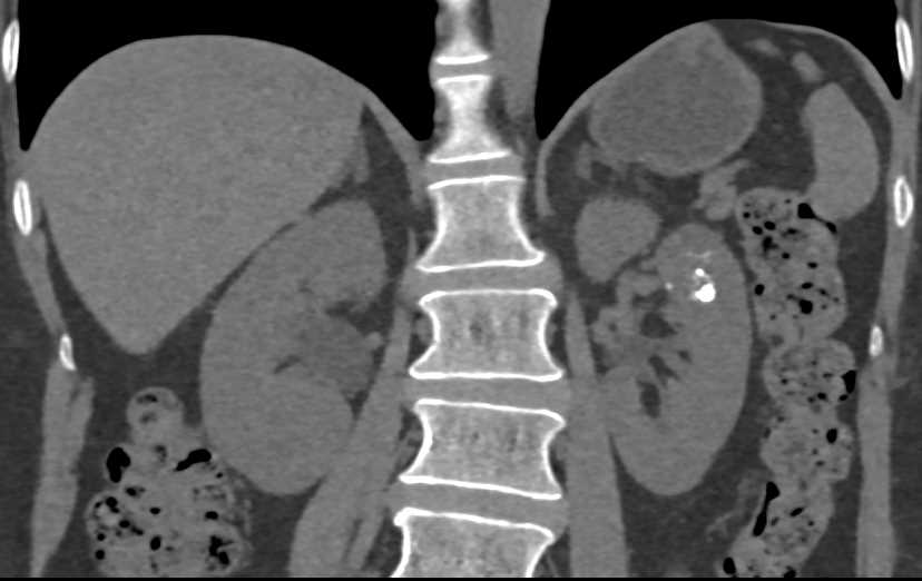 Bosniak 2F Cyst Left Kidney - CTisus CT Scan