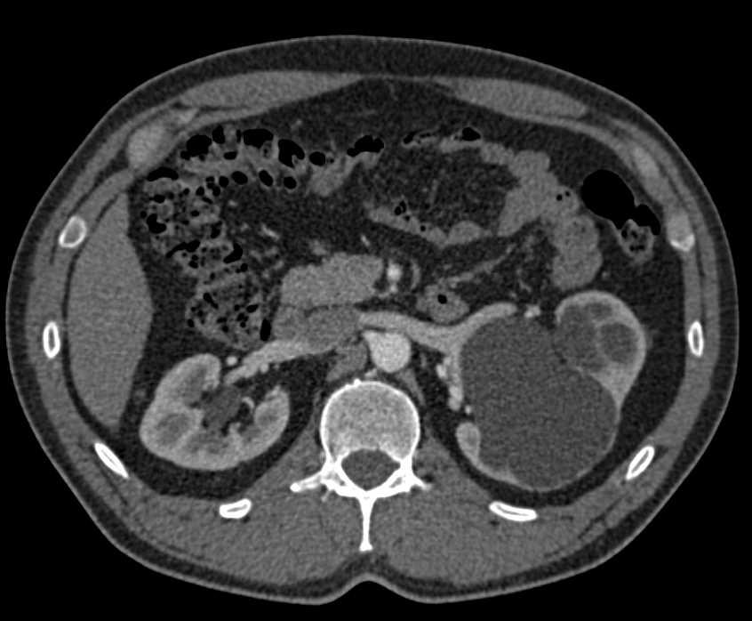 Left Ureteropelvic Junction (UPJ) Obstruction with Hydronephrosis - CTisus CT Scan