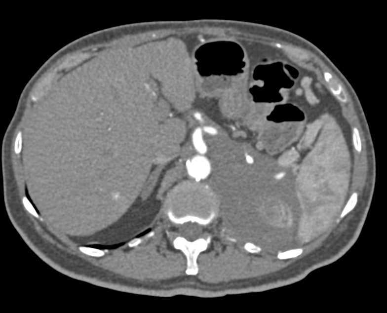 Infiltration of the Left Pararenal Space due to Lymphoma - CTisus CT Scan
