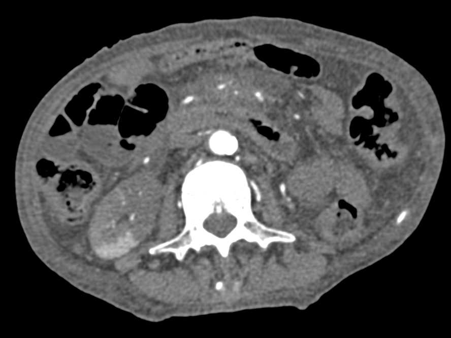 Renal Infarct in a Patient With Spread of Pancreatic Cancer - CTisus CT Scan