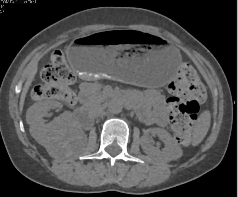 Papillary Renal Cell Carcinoma Right Kidney - CTisus CT Scan