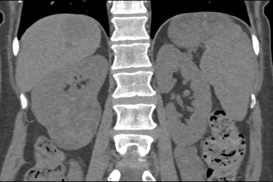 Papillary Renal Cell Carcinoma Right Kidney - CTisus CT Scan