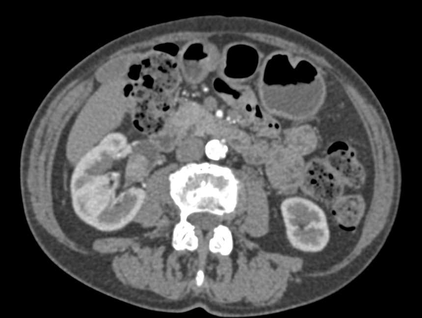 Transitional Cell Cancer (TCC) Right Renal Pelvis - CTisus CT Scan