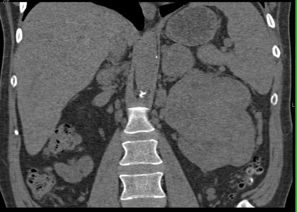 Left Renal Cell Carcinoma with Adrenal Metastases - CTisus CT Scan