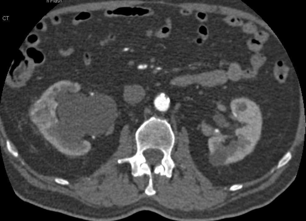 Incidental 2cm Right Renal Cell Carcinoma - CTisus CT Scan