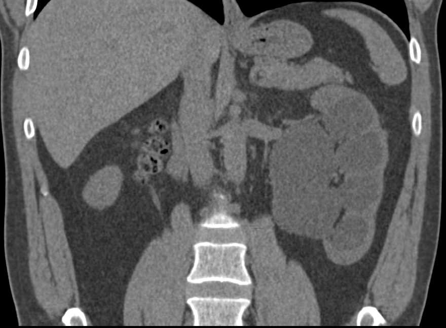 Left Ureteropelvic Junction (UPJ) Obstruction with Hydronephrosis - CTisus CT Scan