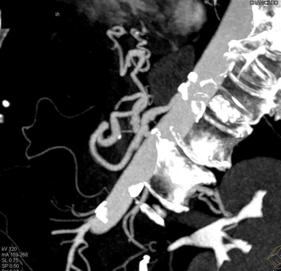 Fibromuscular Dysplasia (FMD) Left Renal Artery - CTisus CT Scan
