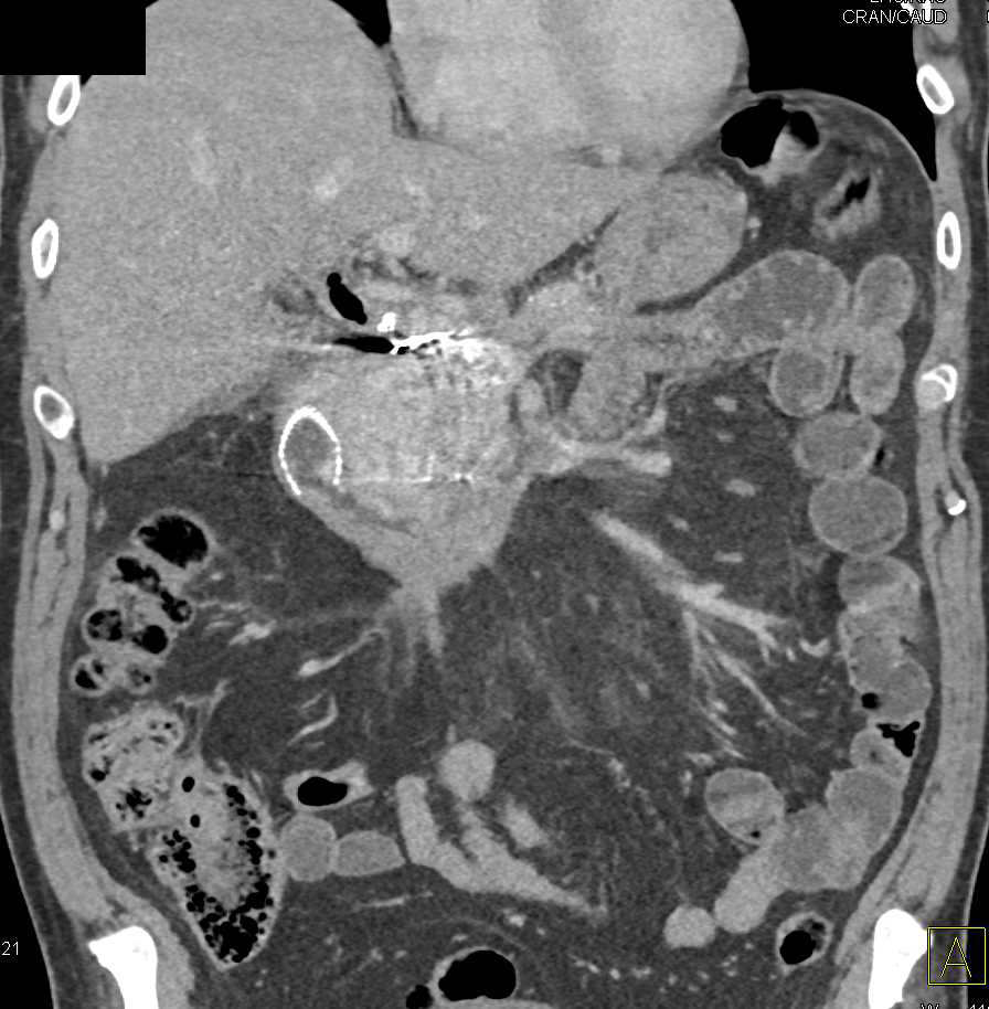 Metastatic Renal Cell Carcinoma to the Head of the Pancreas and Invades Duodenum - CTisus CT Scan