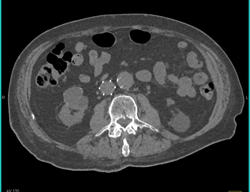 Bosniak 2F Cyst Right Kidney - CTisus CT Scan