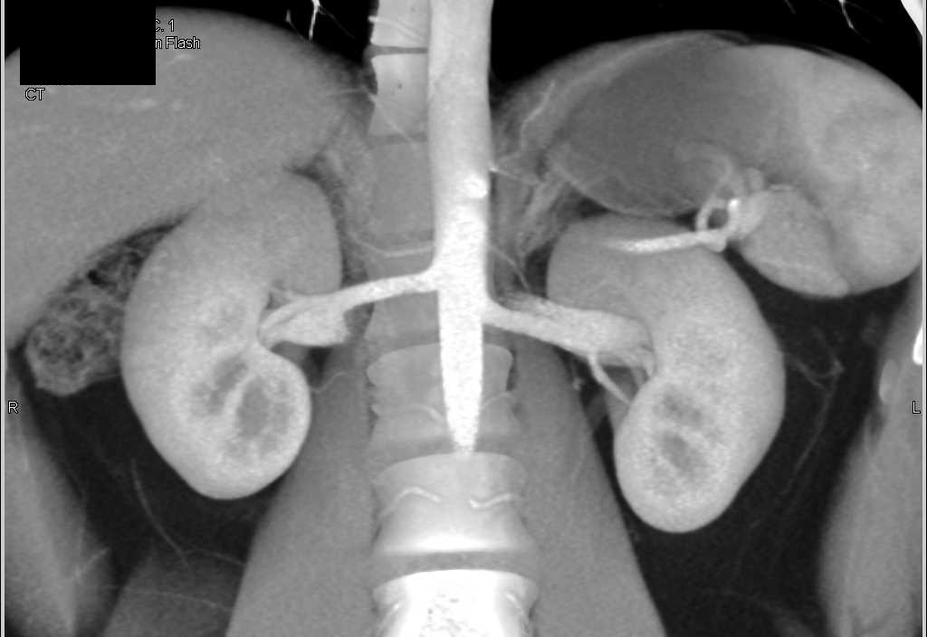 Normal Renal Arteries - CTisus CT Scan