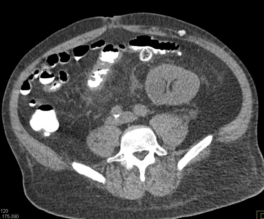Enteritis in a Renal Transplant Patient - CTisus CT Scan