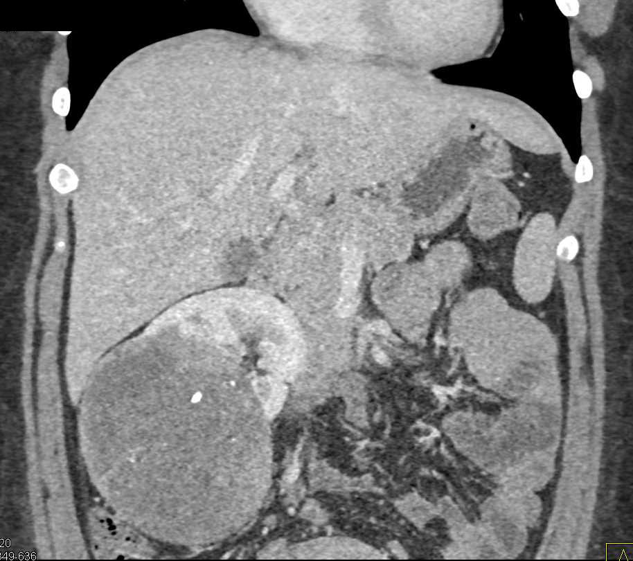 Clear Cell Renal Cell Carcinoma Right Kidney which is Hypovascular - CTisus CT Scan