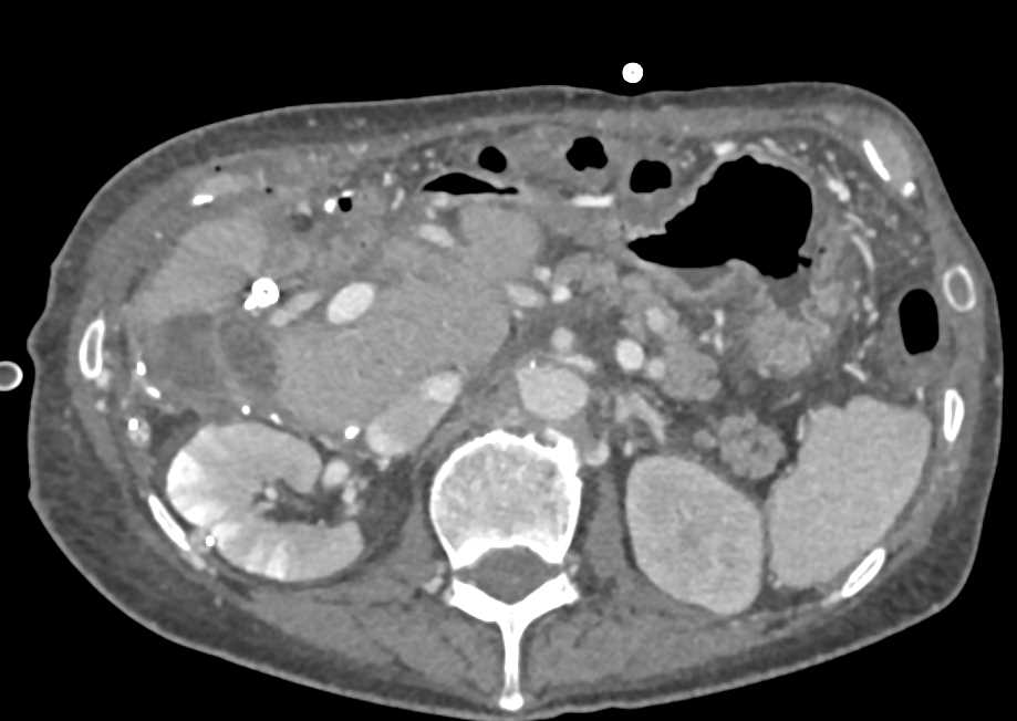 Retained Contrast in the Tubules Right Kidney Usually Means Renal Failure but may also be seen in Infection - CTisus CT Scan