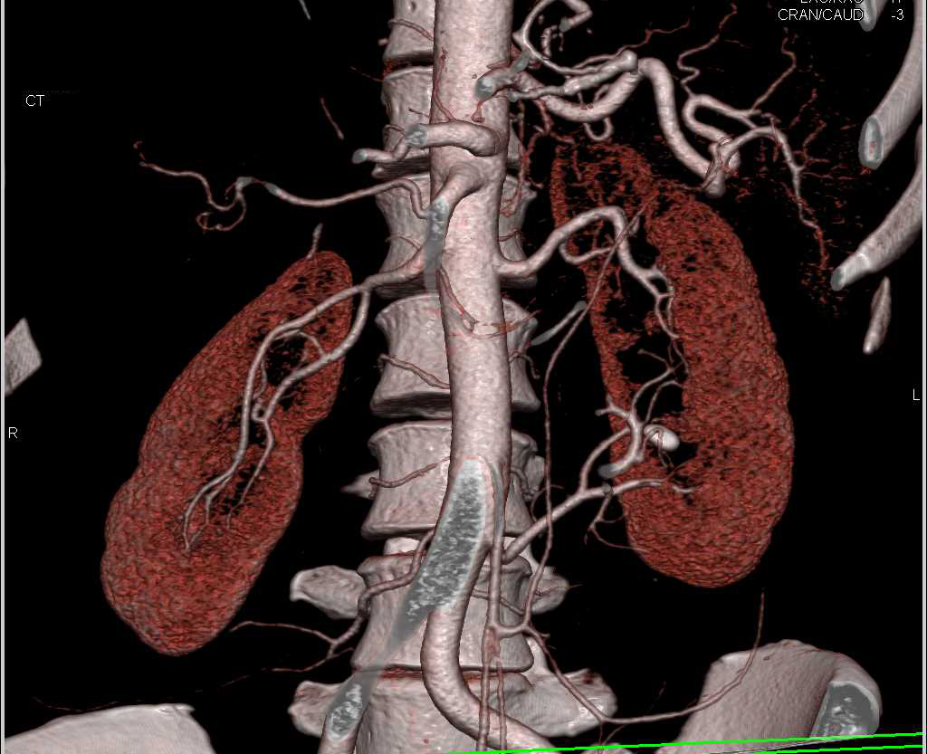Dilated Upper Pole Left Kidney with 2 Left Renal Arteries - CTisus CT Scan