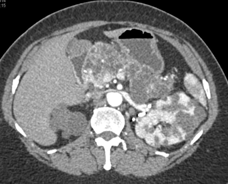 Von Hippel-Lindau syndrome (VHL) with Multiple Renal Carcinoma and Cysts as well as Pancreatic Cysts - CTisus CT Scan