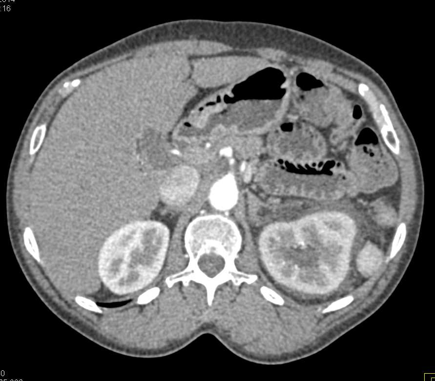 Obstructed Left Kidney with Delayed Function and Perirenal Fluid - CTisus CT Scan