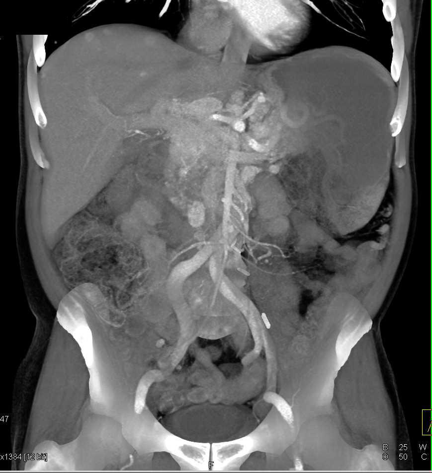 Metastatic Renal Cell Carcinoma to the Pancreas, Contralateral Kidney and Nodes - CTisus CT Scan