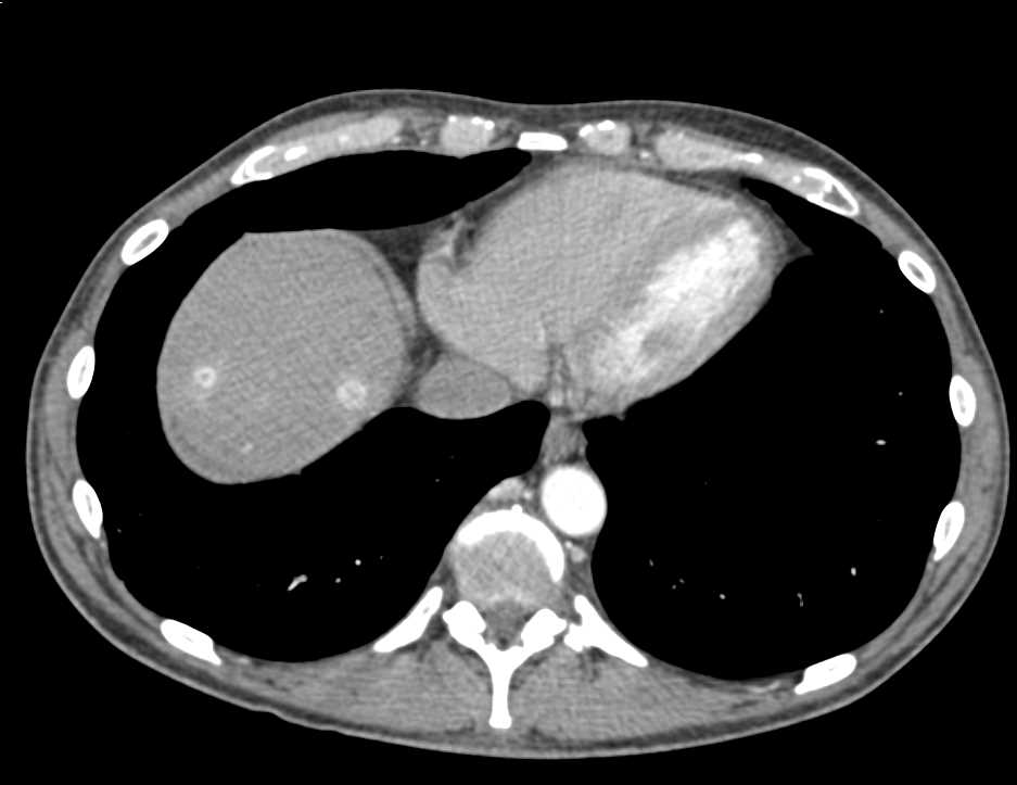 Metastatic Renal Cell Carcinoma to the Pancreas, Contralateral Kidney, Liver and Nodes - CTisus CT Scan