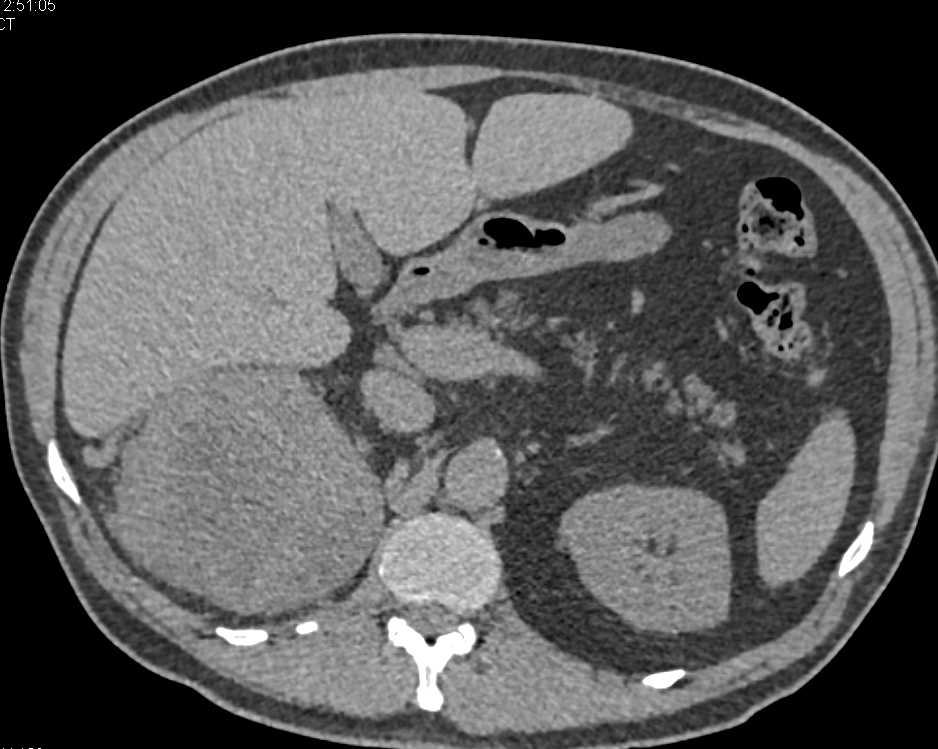 Clear Cell Renal Cell Carcinoma Right Kidney - CTisus CT Scan
