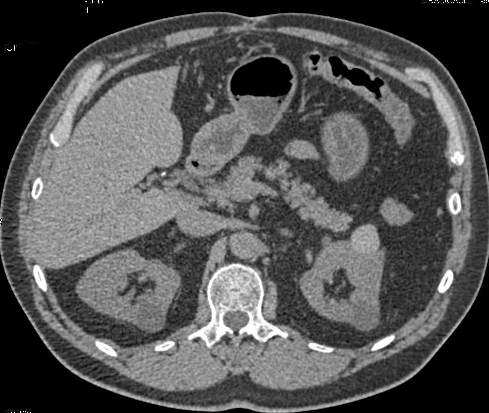 High Density Left Renal Cyst - CTisus CT Scan