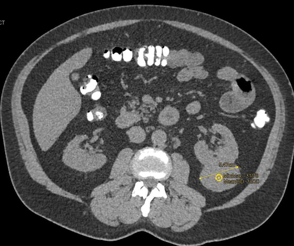 Papillary Renal Cell Carcinoma with Mild Enhancement - CTisus CT Scan
