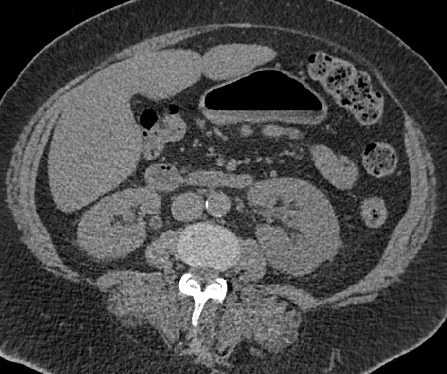 Acute Pyelonephritis Best Seen in the Left Kidney - CTisus CT Scan