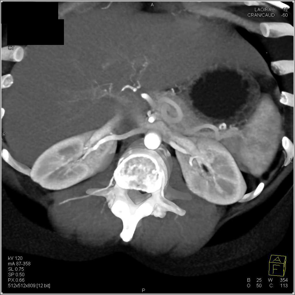 Normal Renal Arteries - CTisus CT Scan