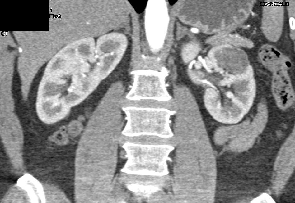 Cystic Renal Cell Carcinoma Left Kidney - CTisus CT Scan