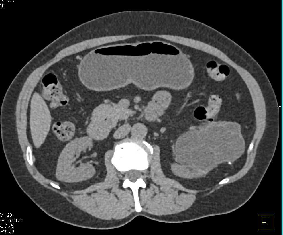 Bosniak 3 Cyst - CTisus CT Scan