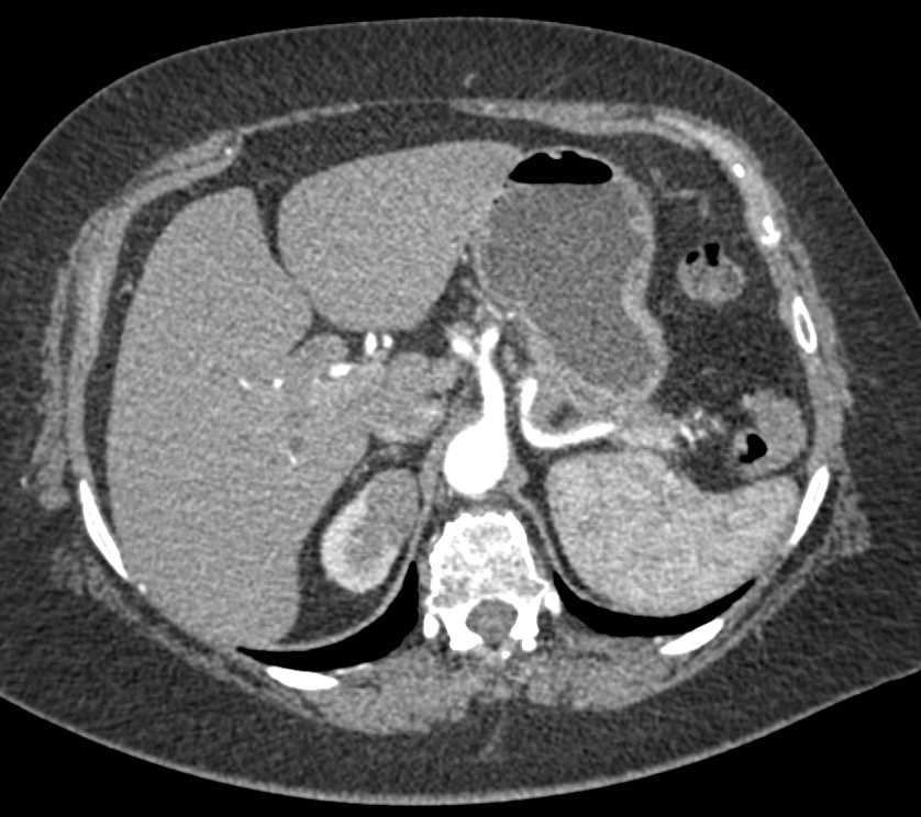 Pancreatic Cancer with Incidental Renal Cell Carcinoma Upper Pole Right Kidney - CTisus CT Scan