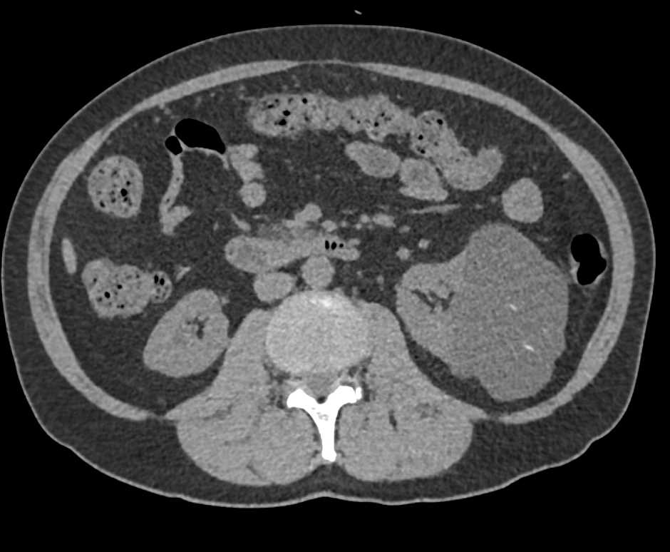 Bosniak I Renal Cyst Left Kidney - CTisus CT Scan