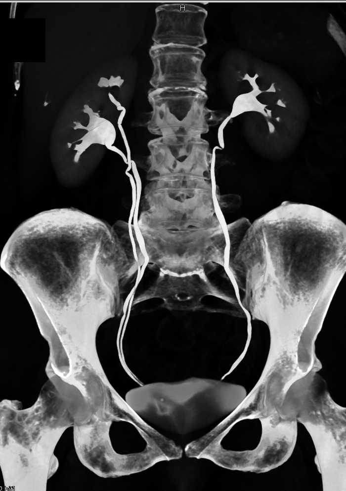 ct urogram protocol radiopaedia