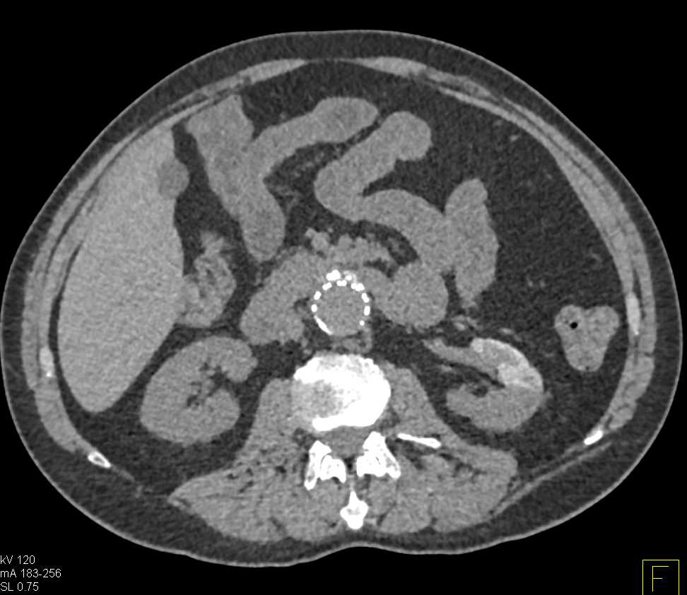Retained Contrast in Lower Pole Left Kidney Looks Different When More Contrast is Given - CTisus CT Scan