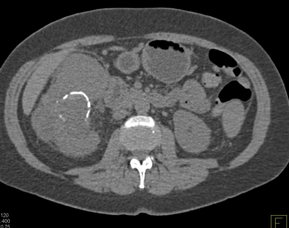 Renal Cell Carcinoma with Dystrophic Calcification - CTisus CT Scan