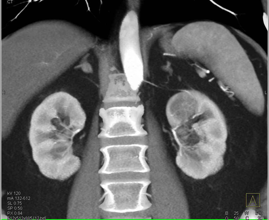 Incidental Carcinoma Upper Pole Left Kidney - CTisus CT Scan