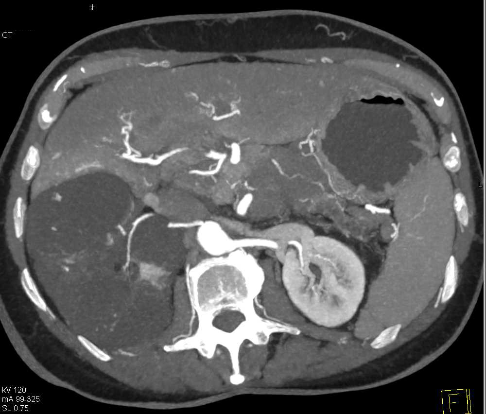 Mixed Epithelial Stromal Tumor (MEST) Kidney - CTisus CT Scan