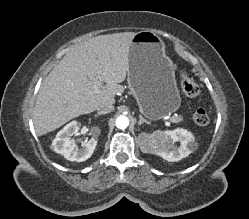Papillary Renal Cell Carcinoma Upper Pole Left Kidney - CTisus CT Scan