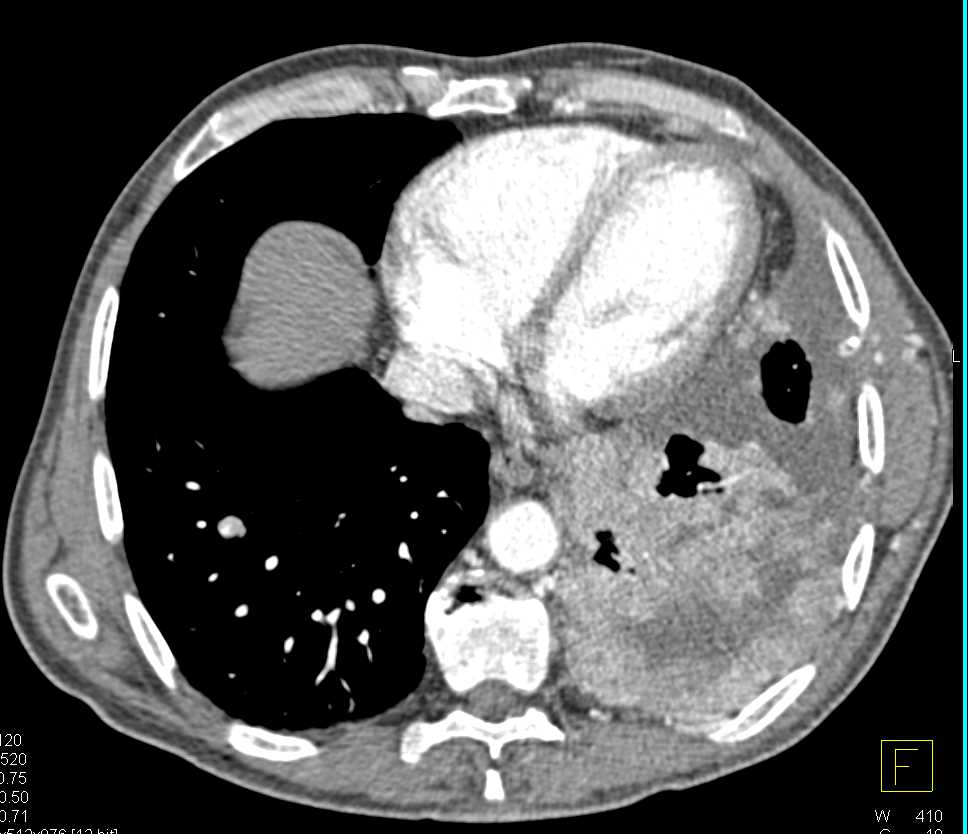 Metastatic Left Renal Cell Carcinoma to the Left Pleural Space - CTisus CT Scan