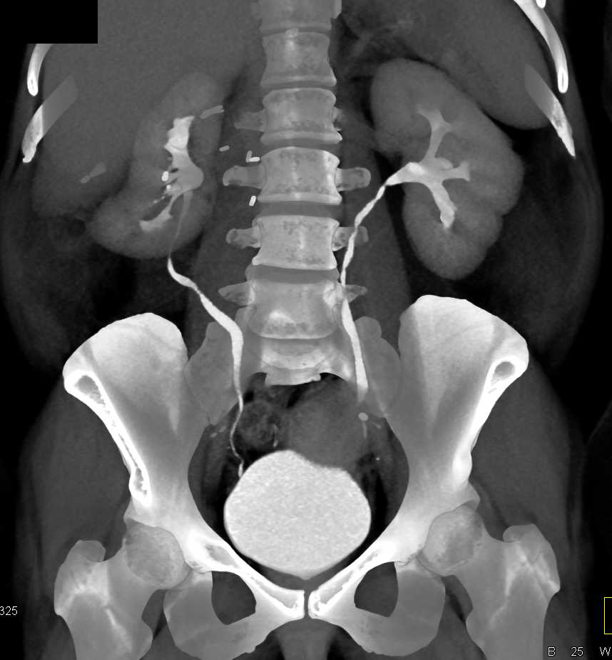 Renal Cell Carcinoma Upper Pole Right Kidney - CTisus CT Scan