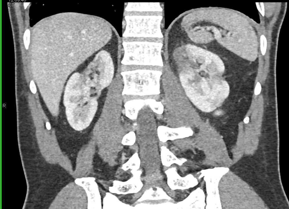 Acute and Chronic Pyelonephritis - CTisus CT Scan