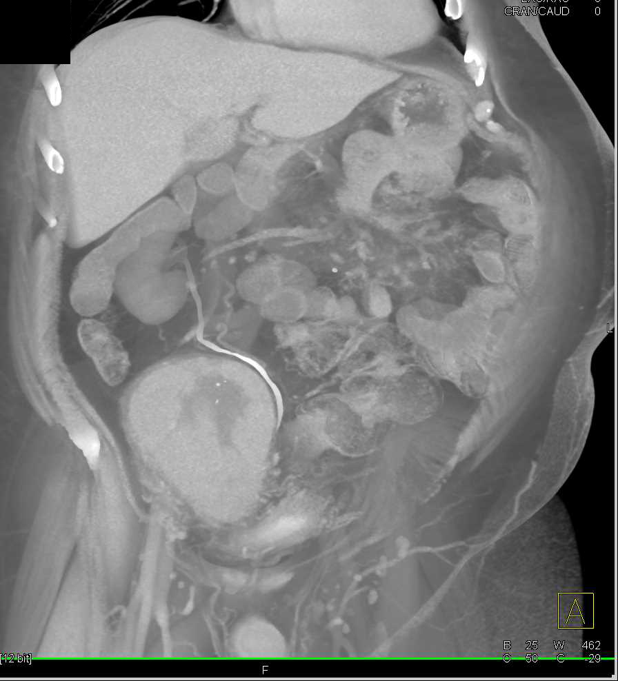Rejected Renal Transplant - CTisus CT Scan