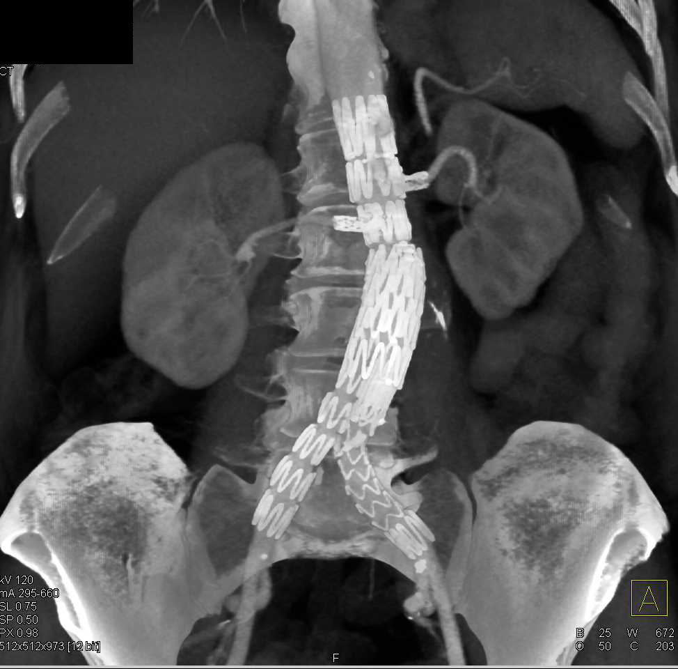 Patent Stent in the Right Renal Artery - CTisus CT Scan