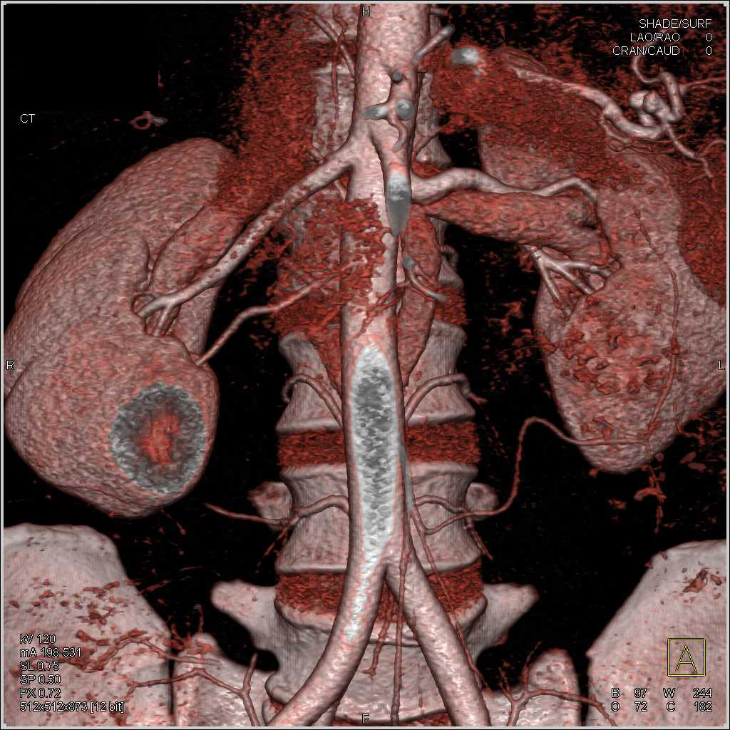 Two Right Renal Arteries - CTisus CT Scan