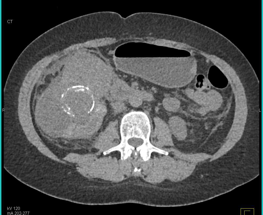 Metastatic Clear Cell Renal Cell Carcinoma - CTisus CT Scan