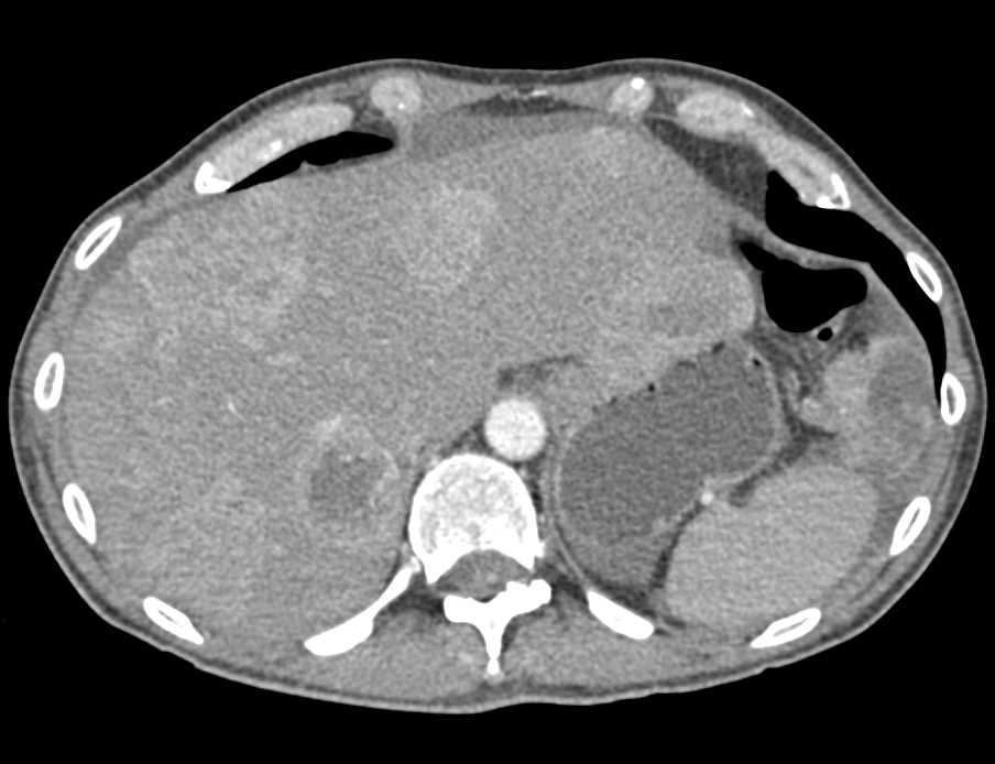 Metastatic Renal Cell Carcinoma - CTisus CT Scan